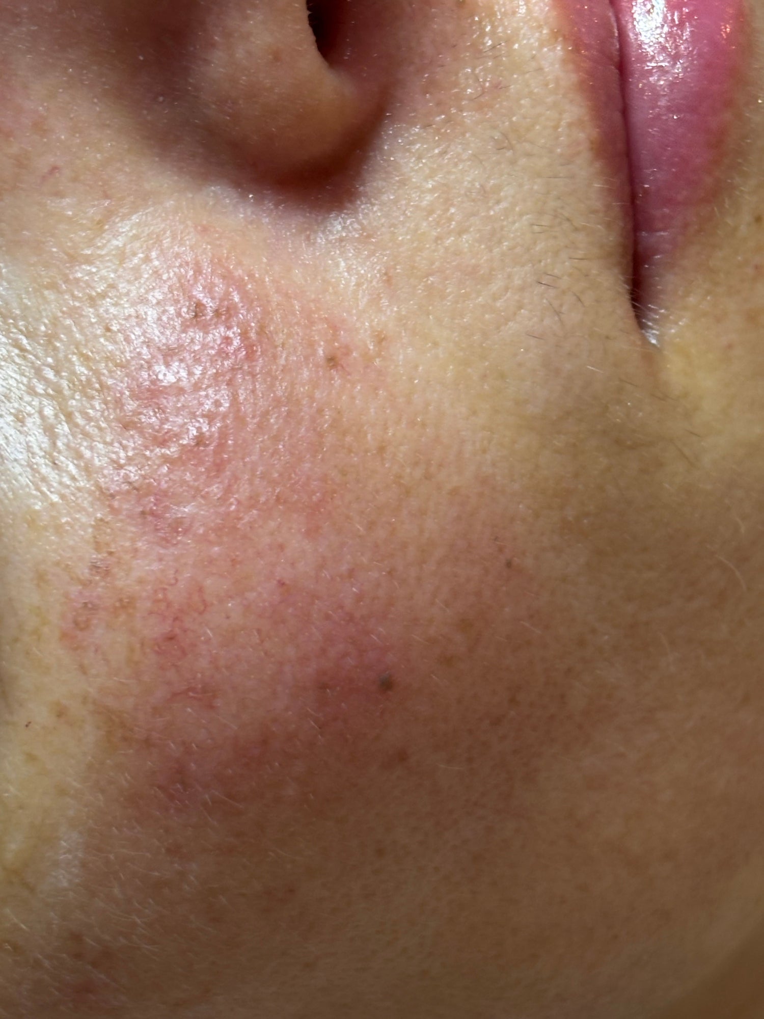 Understanding Rosacea + Treatment Options