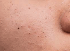 What is the best way to remove blackheads?