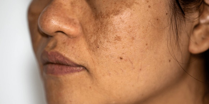 What Is Pigmentation and How Do I Treat It?